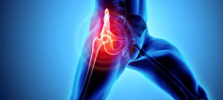 Hip Replacement Surgery in Dubai - Best Hip Surgeons Dubai