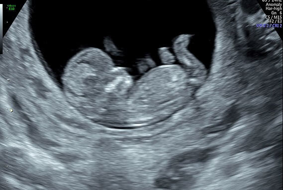 Obstetric Dating Scan Viability Telegraph 