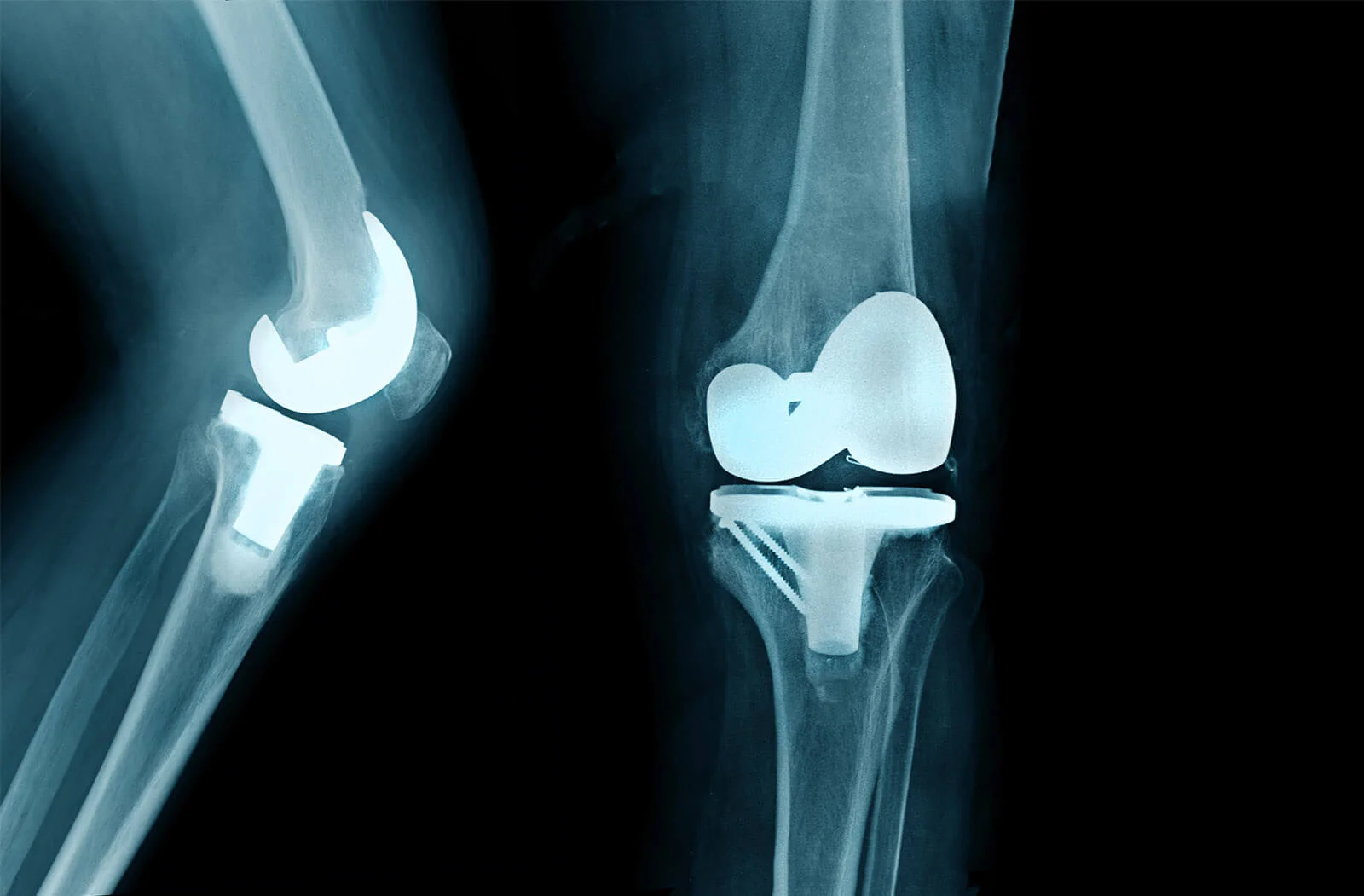 bilateral knee replacement surgery Dubai